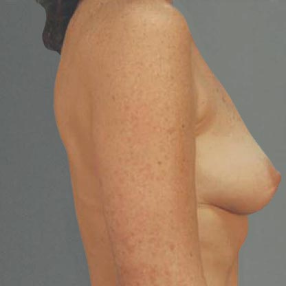 vue de profil de la patiente avant les implants mammaires à projection faible, Dr Grotting